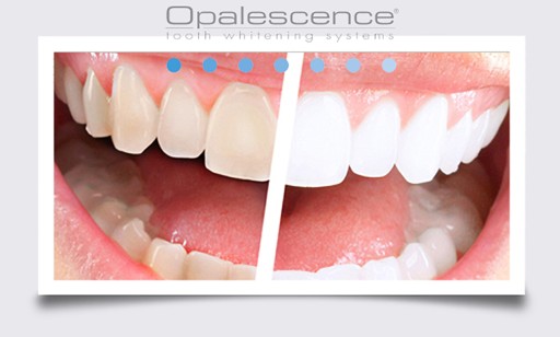 OPALESCENCE PF 1x %16 ОТБЕЛИВАЮЩИЙ ГЕЛЬ ДЛЯ ЗУБОВ США